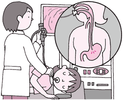 上部消化管(食道・胃・十二指腸)内視鏡検査(胃カメラ)