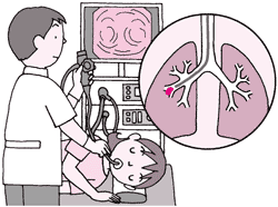 気管支内視鏡検査