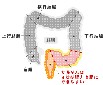 大腸がんはＳ状結腸と直腸にできやすい