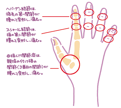 へバーデン結節 ブシャール結節 母指ＣＭ関節症