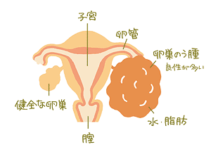 若い世代に多い 卵巣のう腫 プラスコラム Wellness プラスウェルネス