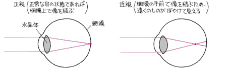 正視と近視