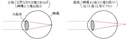 正視と遠視