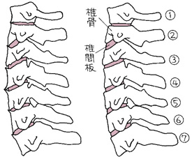 変形した頸椎と正常な頸椎